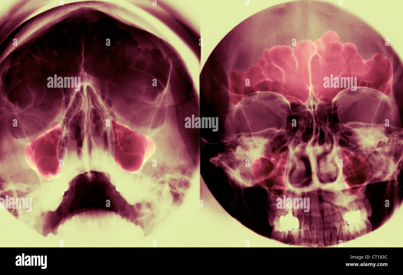 SINUS, XRAY Stock Photo Alamy