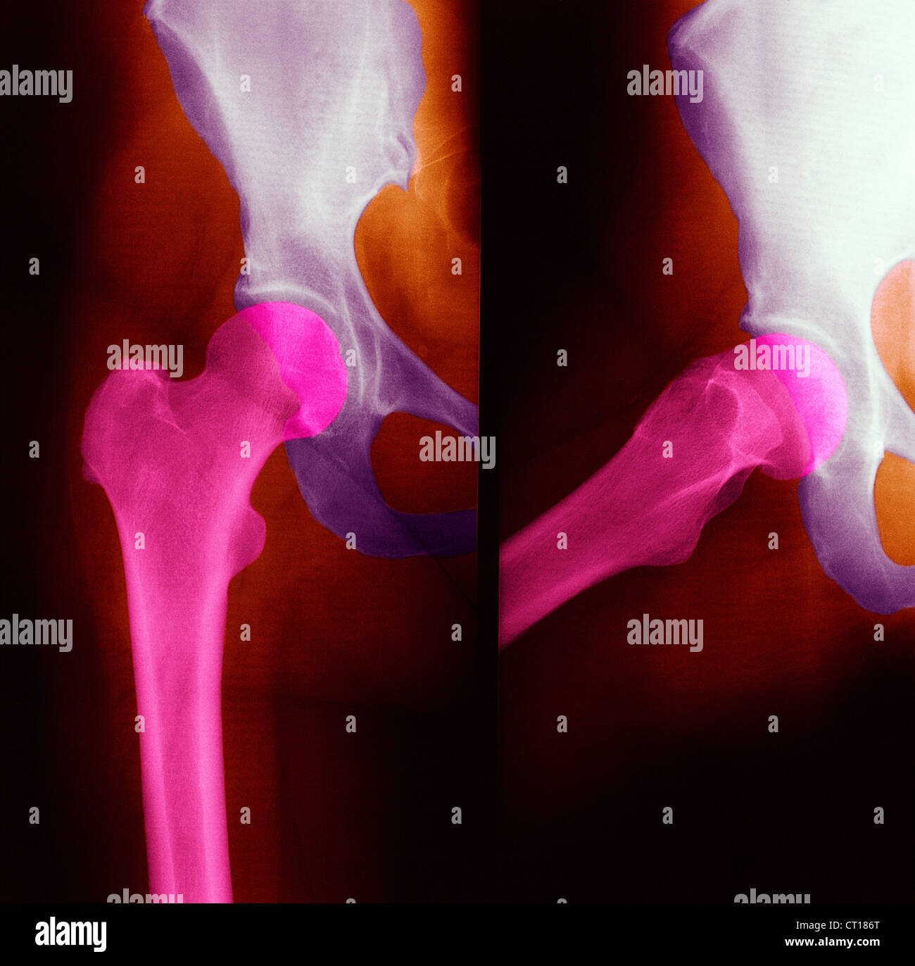 Normal hip x ray hi-res stock photography and images - Alamy