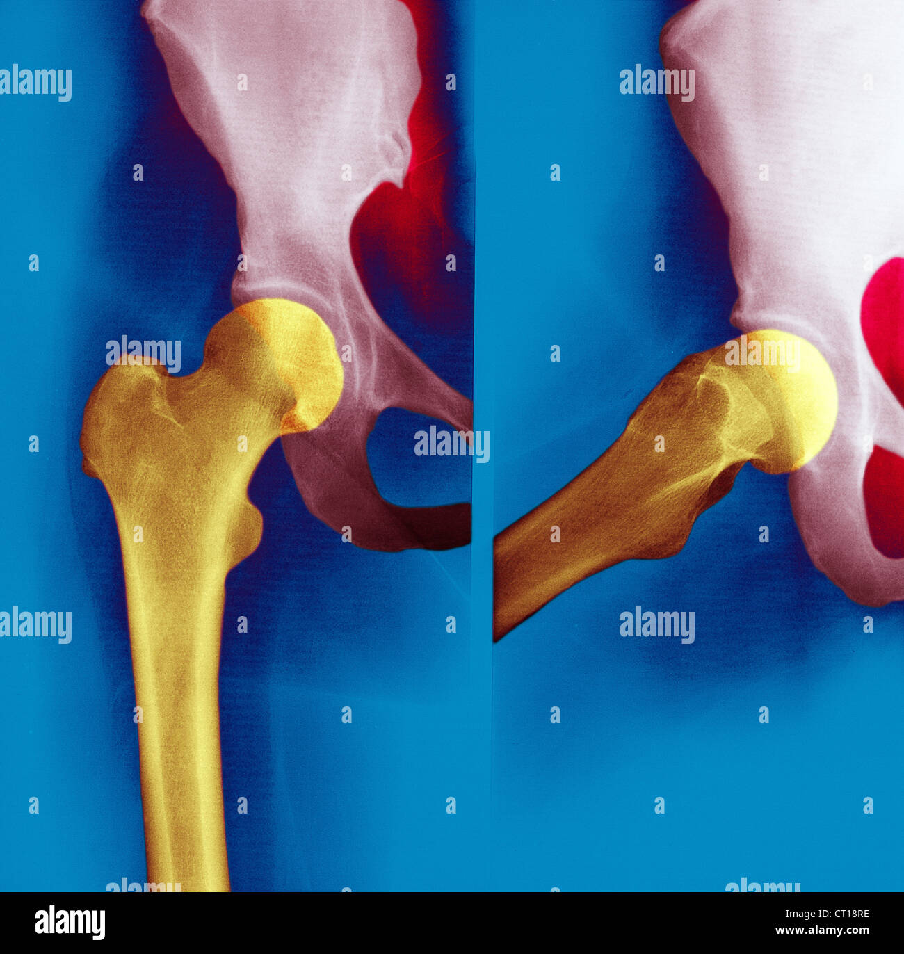 Normal hip x ray hires stock photography and images Alamy
