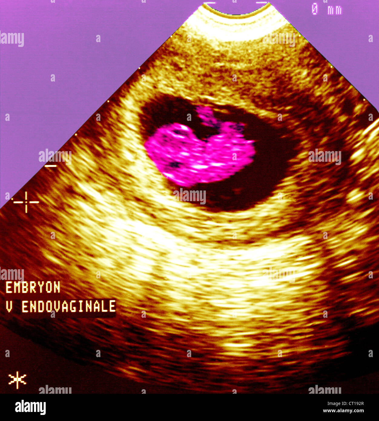 3 months fetus hi-res stock photography and images - Alamy