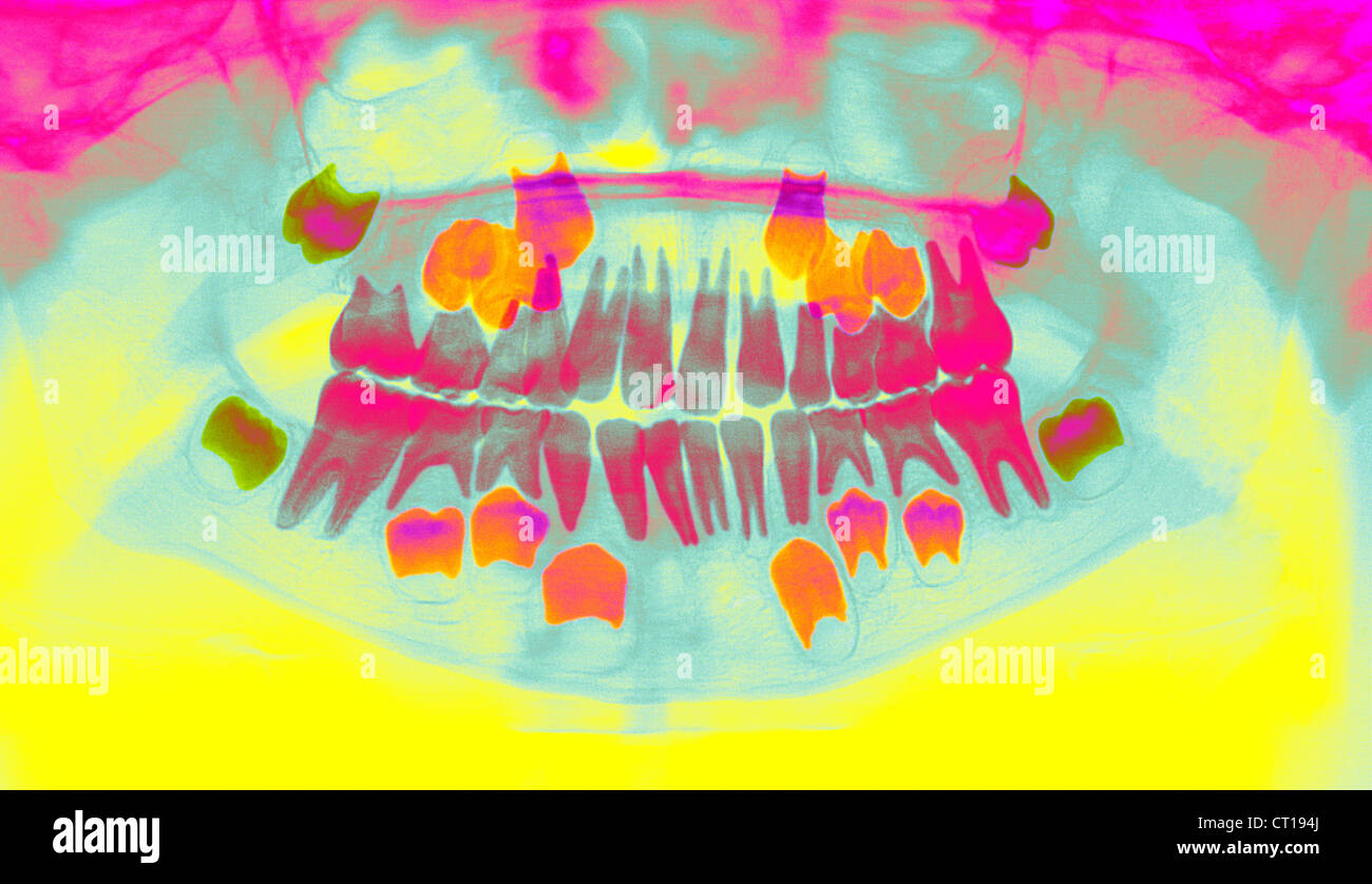 CHILD TOOTH, XRAY Stock Photo Alamy