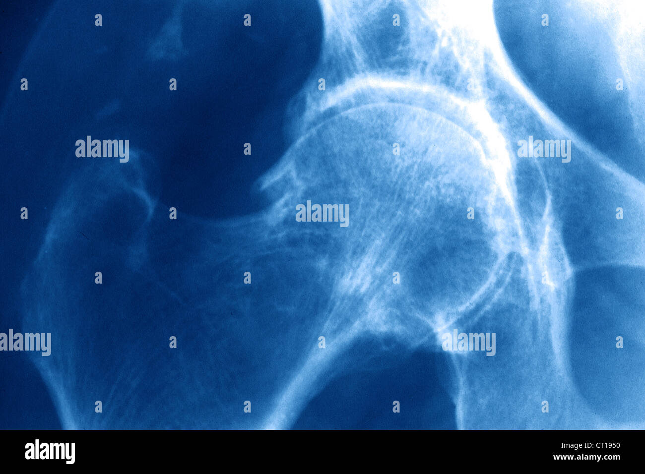 HIP OSTEOARTHRITIS, XRAY Stock Photo Alamy