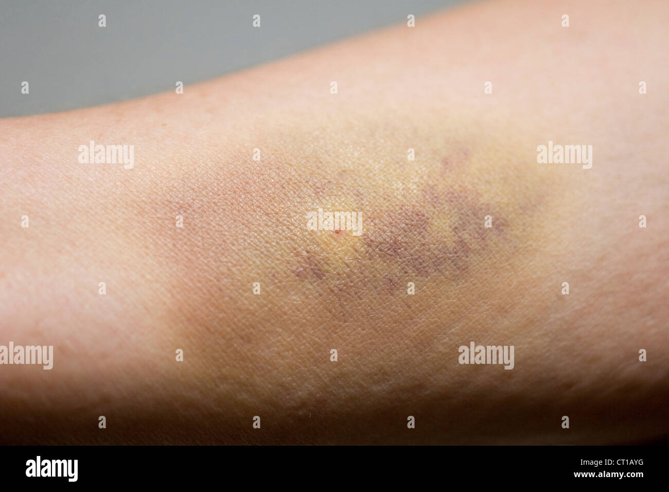 Hematoma Arm Stock Photos & Hematoma Arm Stock Images Alamy
