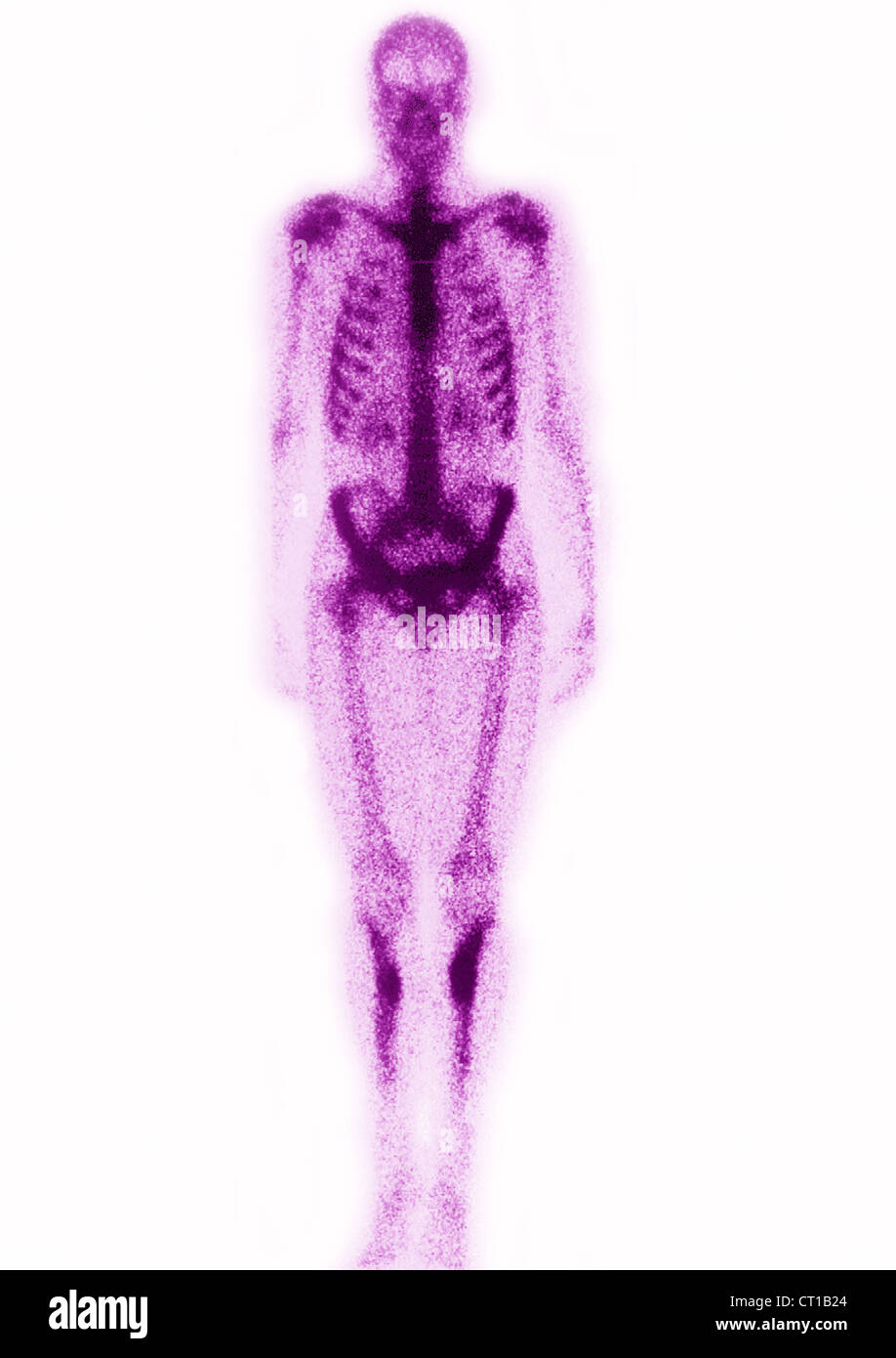 FATIGUE FRACTURE, SCINTISCAN Stock Photo