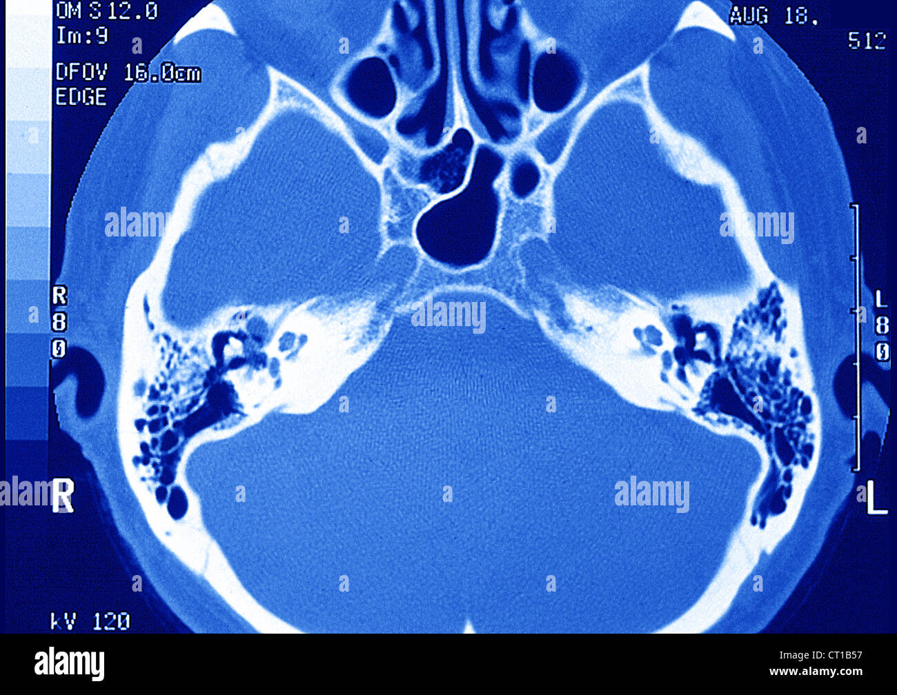INTERNAL EAR, MRI Stock Photo