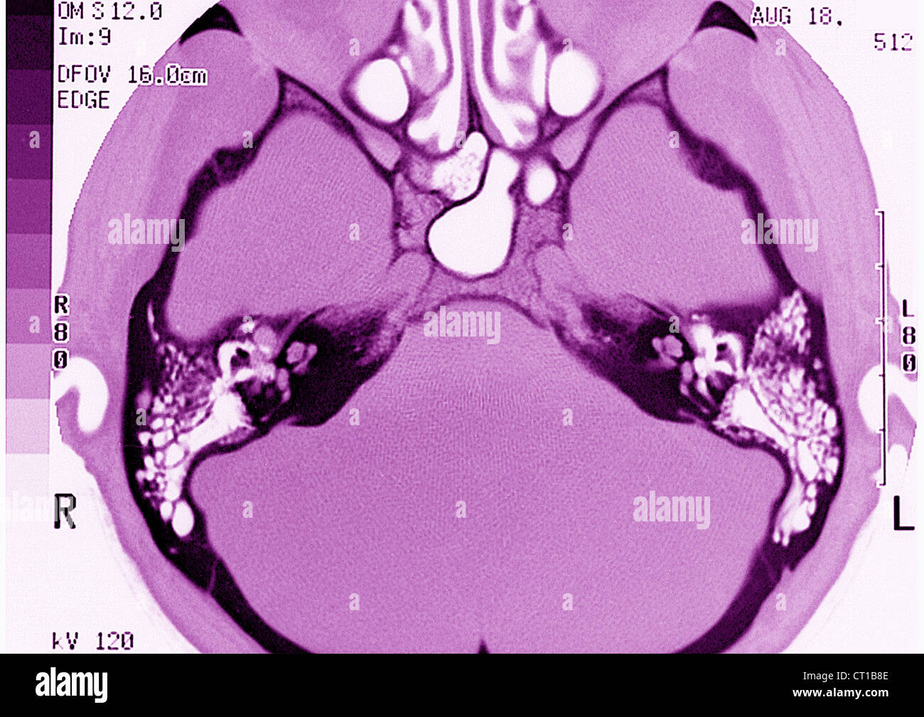 INTERNAL EAR, MRI Stock Photo