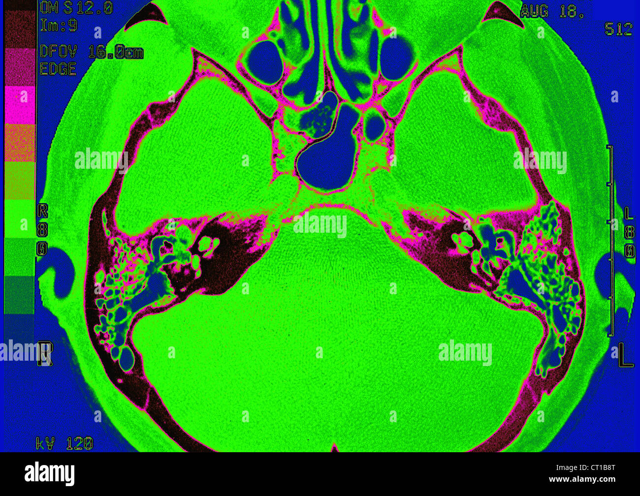 INTERNAL EAR, MRI Stock Photo
