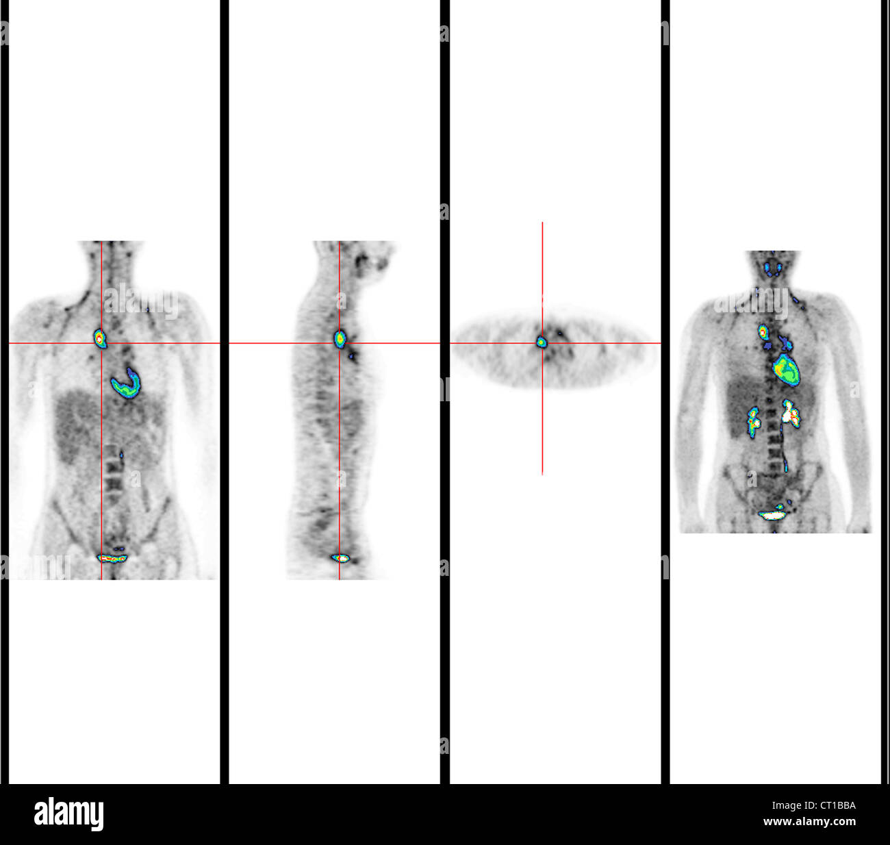 HODGKIN'S DISEASE Stock Photo