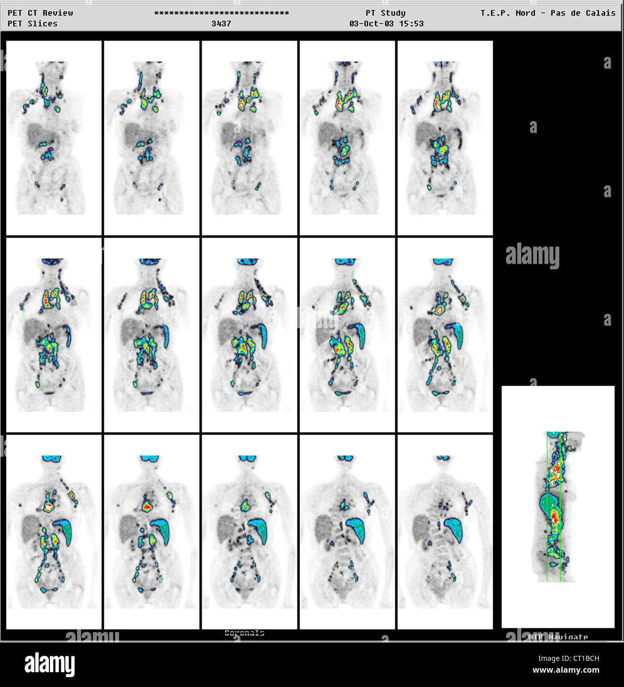 HODGKIN'S DISEASE Stock Photo