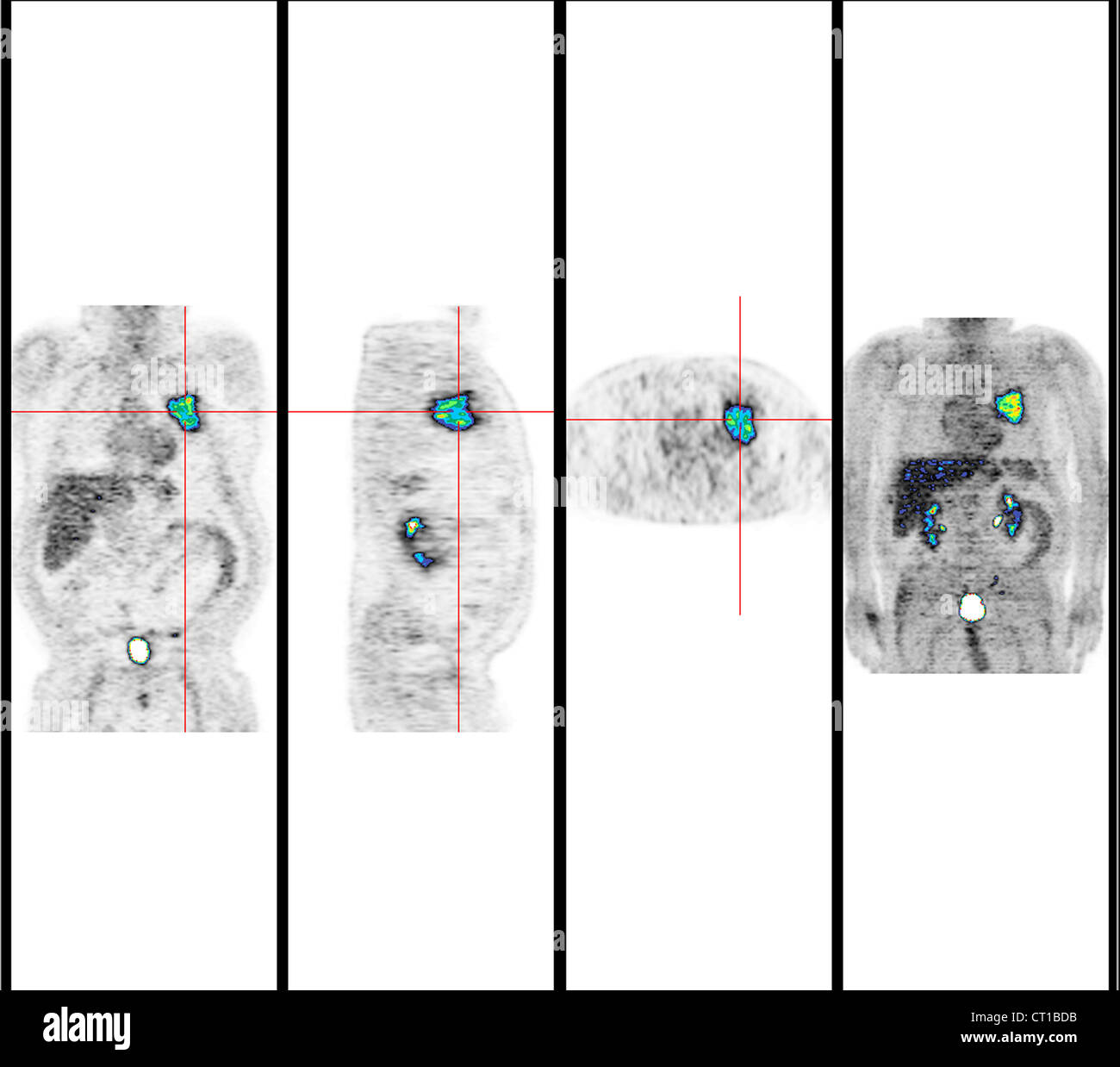 Lung carcinoma hi-res stock photography and images - Alamy