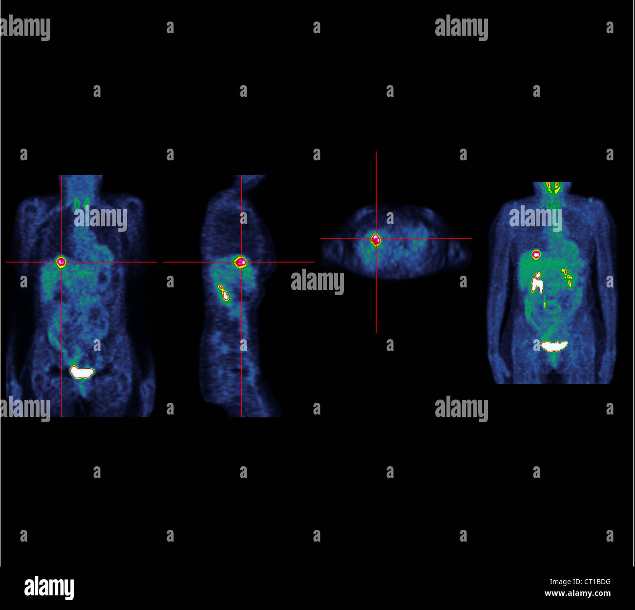 Rectal carcinoma hi-res stock photography and images - Alamy