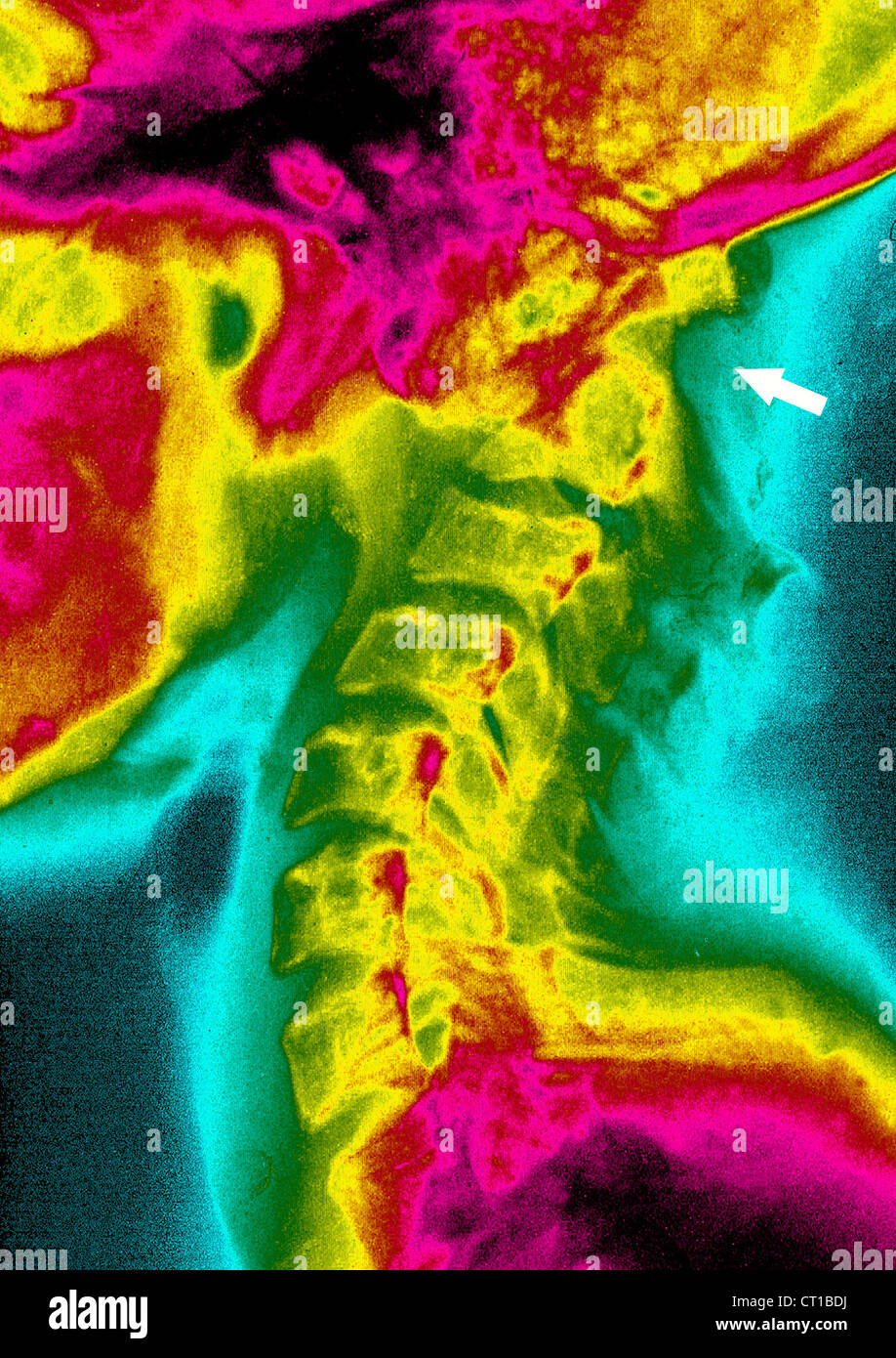 Dislocation shoulder hires stock photography and images Alamy