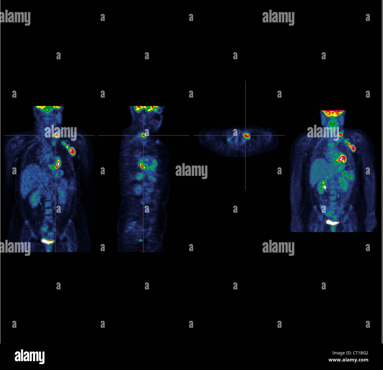 HODGKIN'S DISEASE Stock Photo