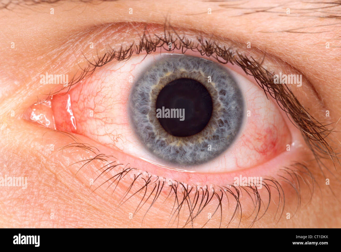 CONJUNCTIVITIS Stock Photo - Alamy