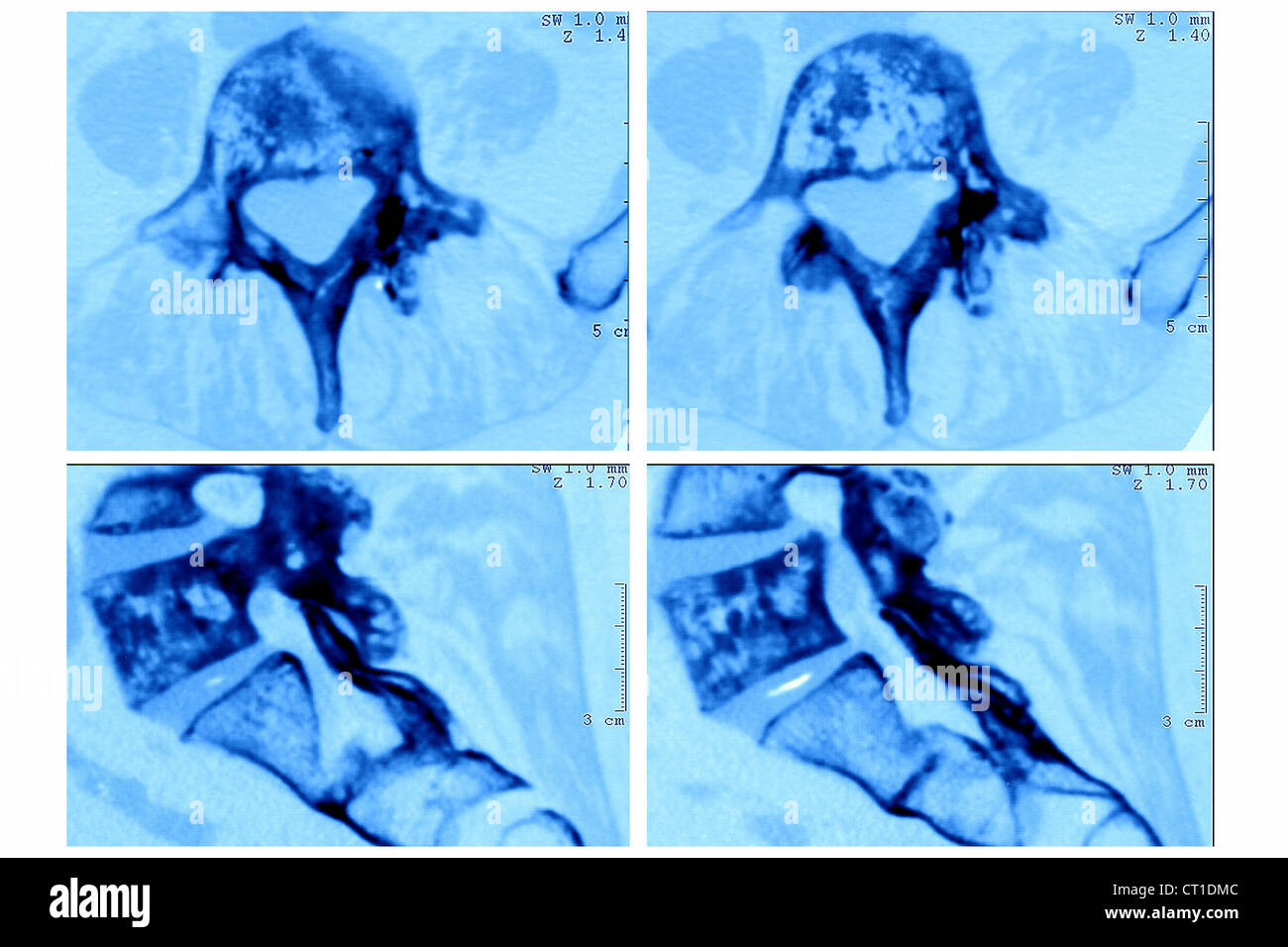 Pagets disease hi-res stock photography and images - Alamy