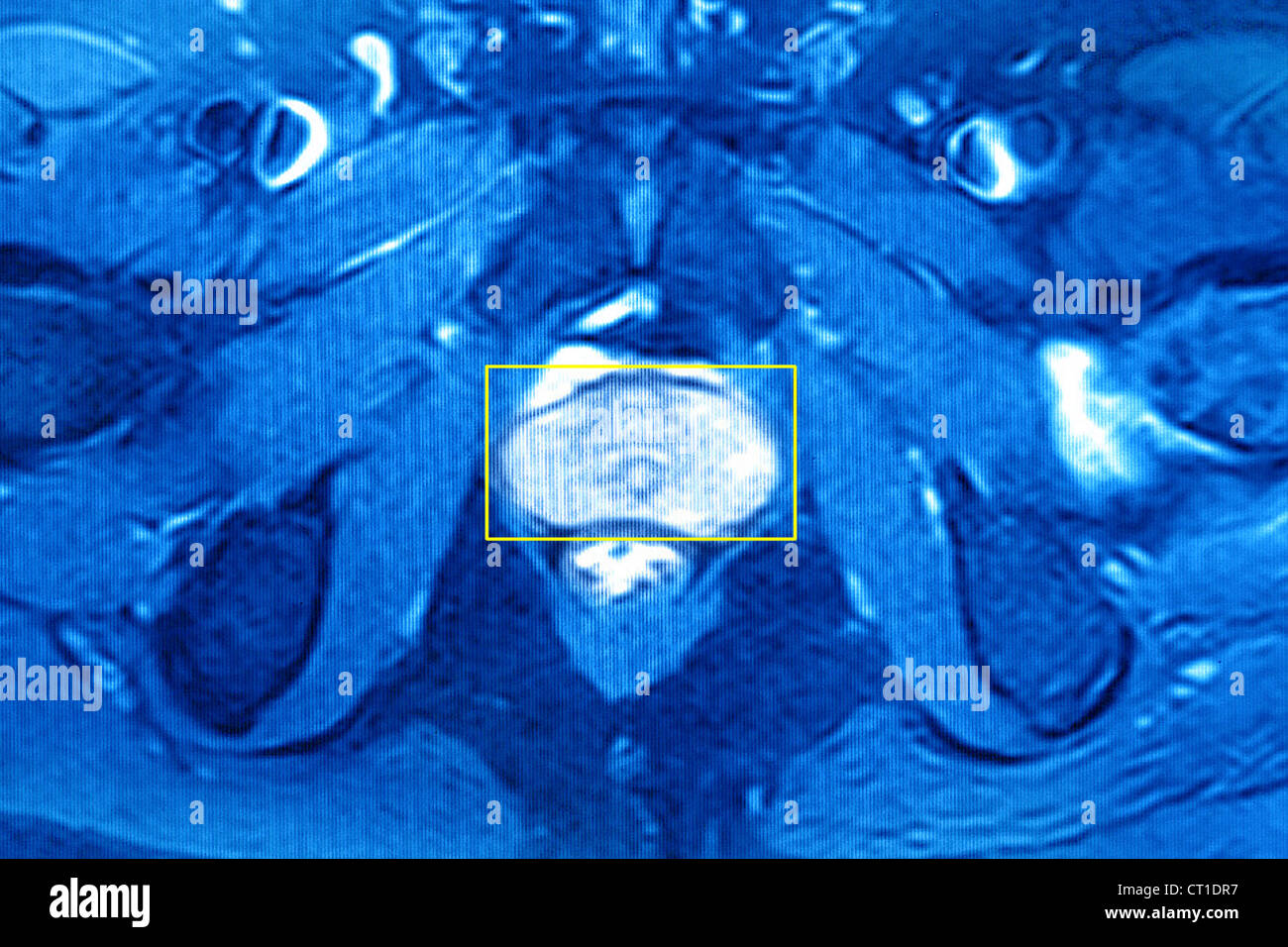 PROSTATE, MRI Stock Photo