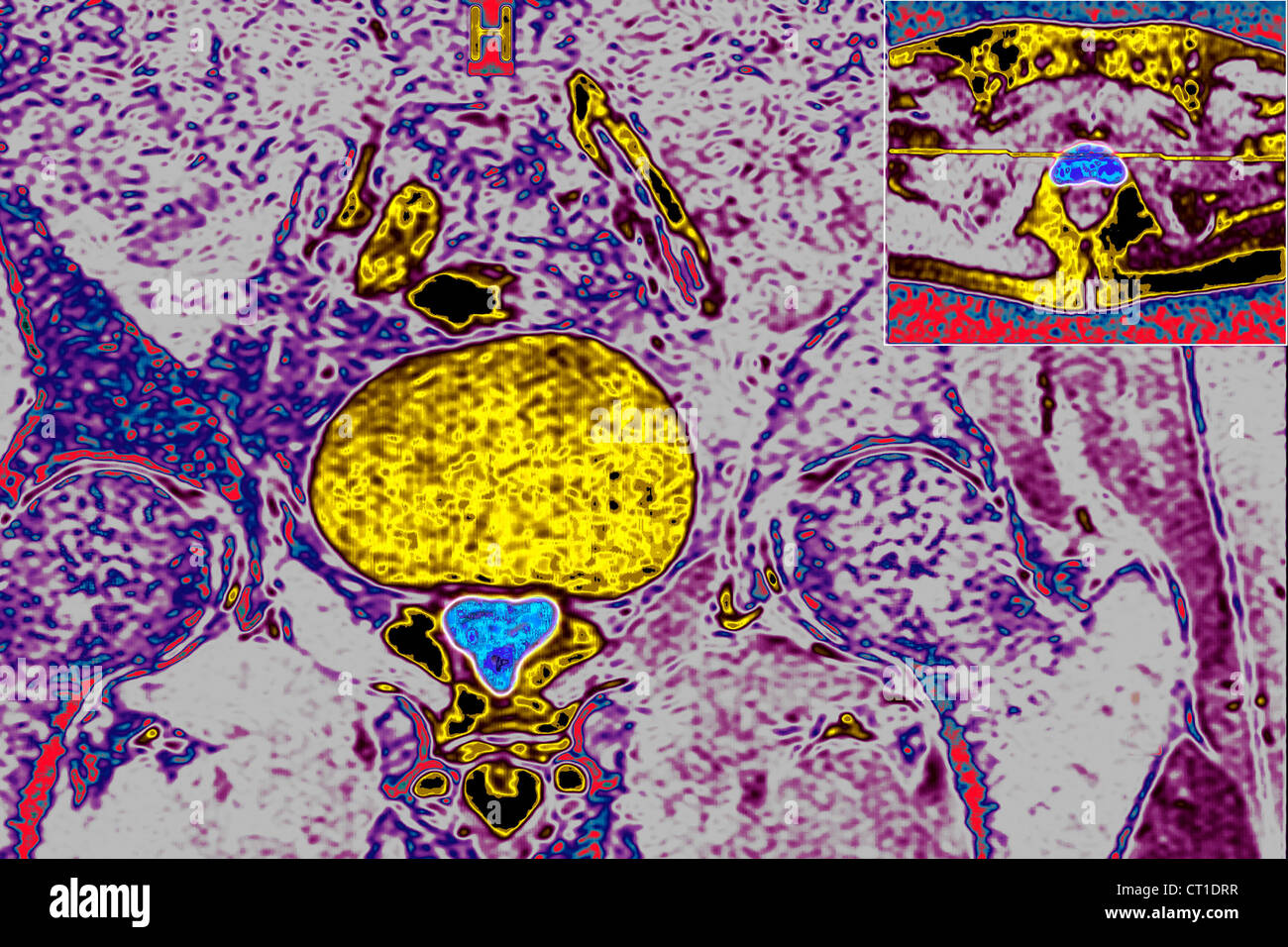 PROSTATE, MRI Stock Photo