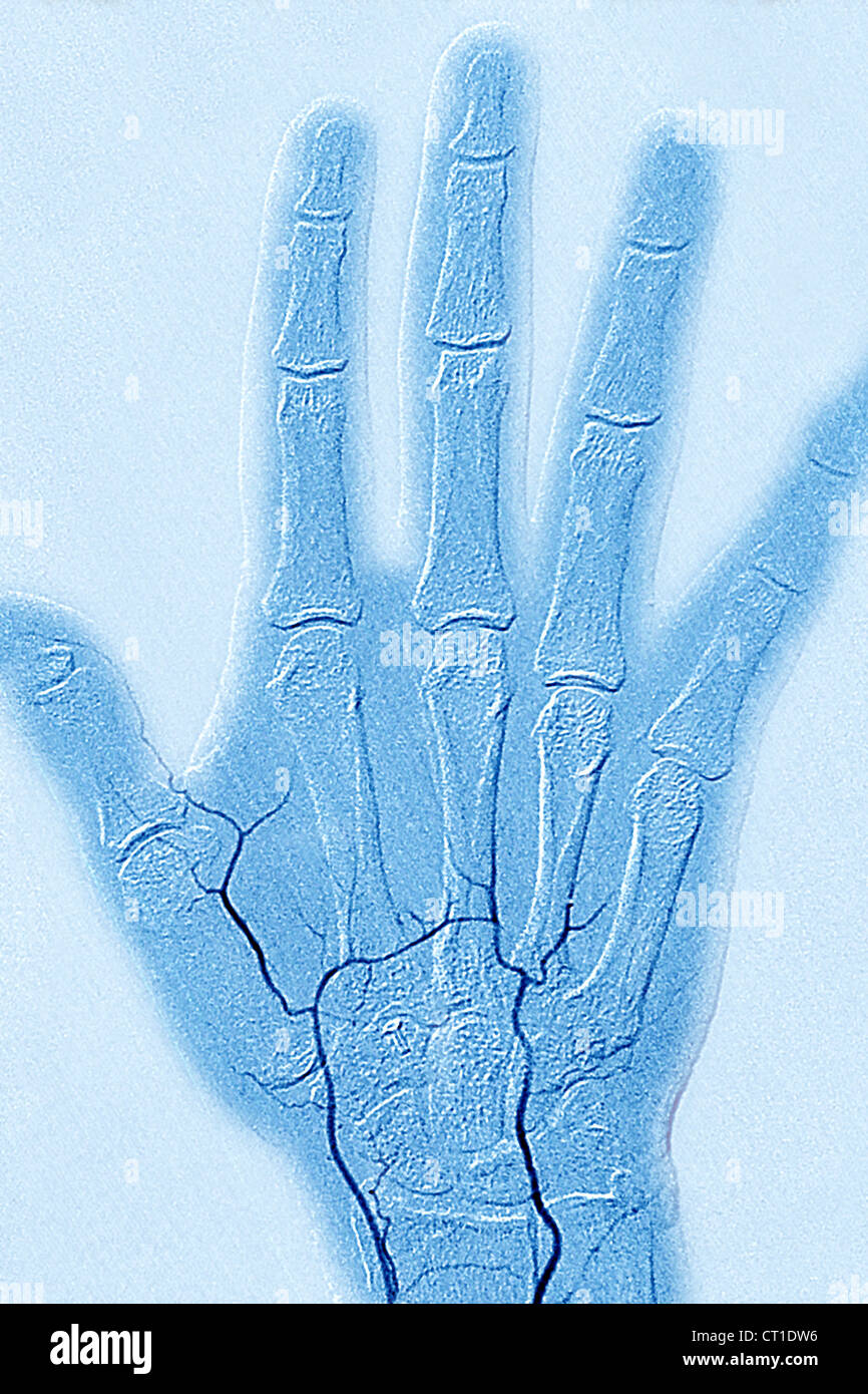 BUERGER'S DISEASE Stock Photo Alamy