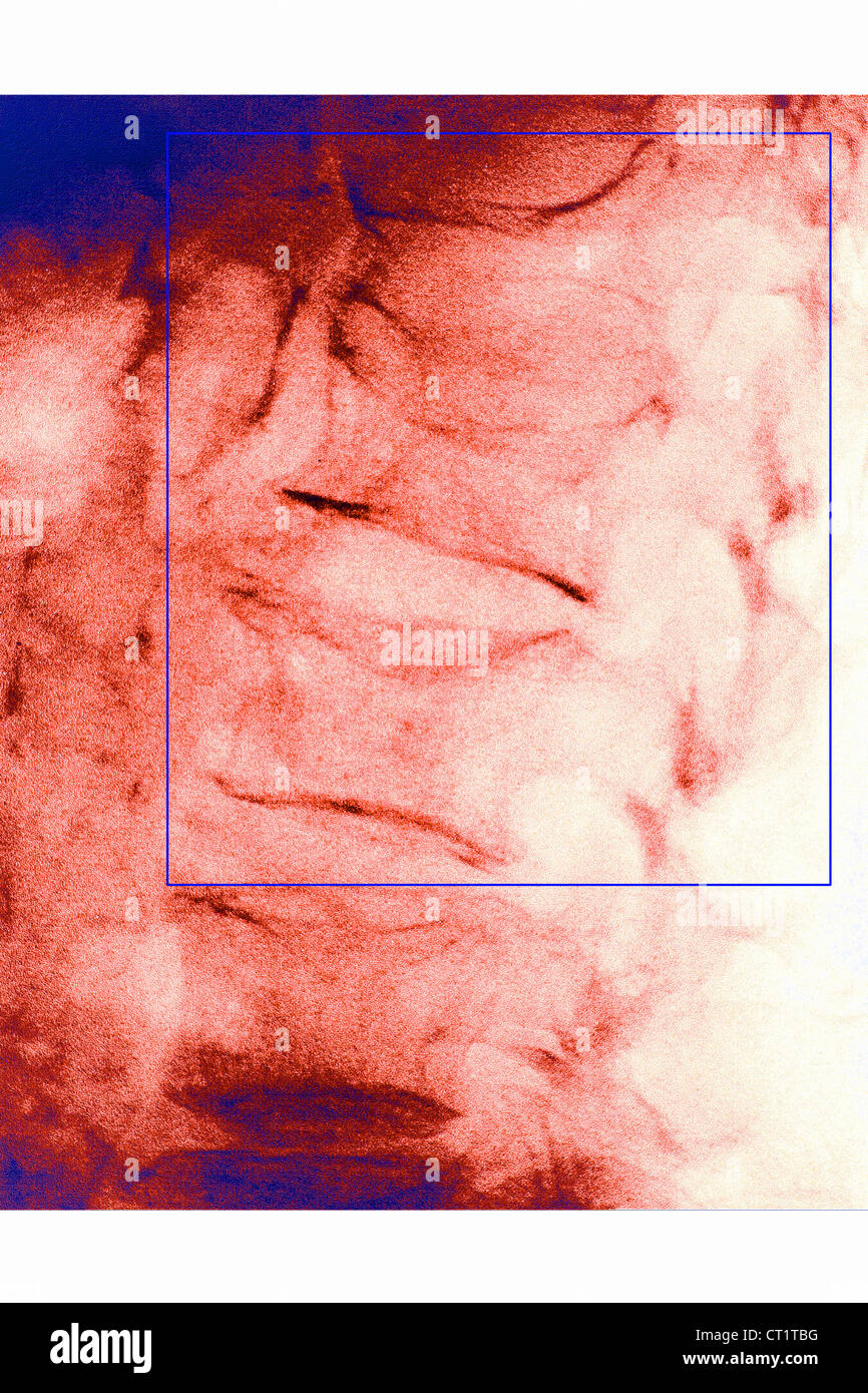 COMPRESSION FRACTURE, XRAY Stock Photo Alamy