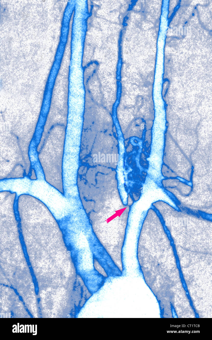 stenosis-of-vertebral-artery-stock-photo-alamy