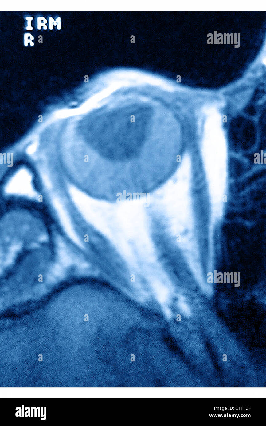 RETINAL DETACHMENT Stock Photo