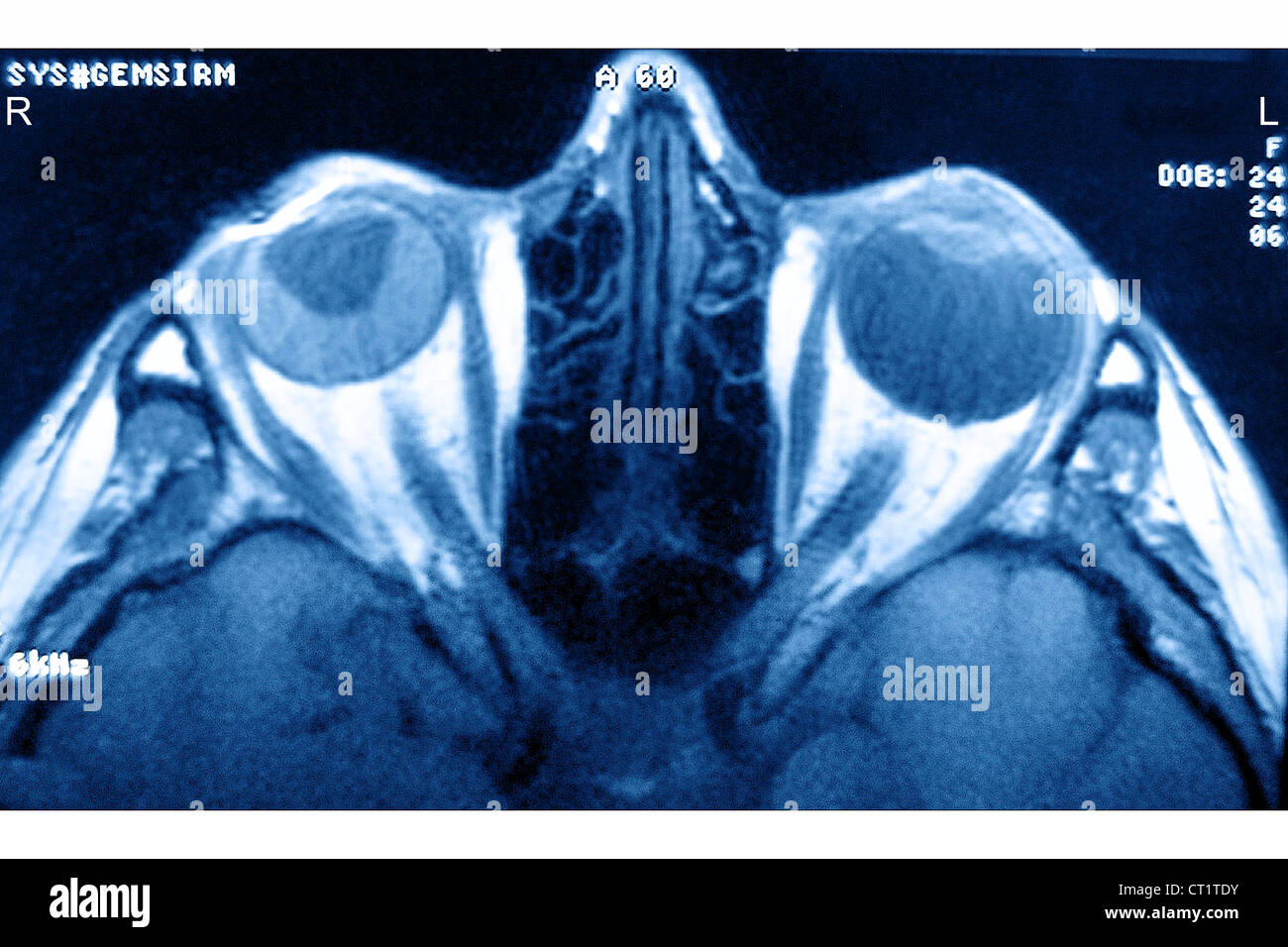 RETINAL DETACHMENT Stock Photo