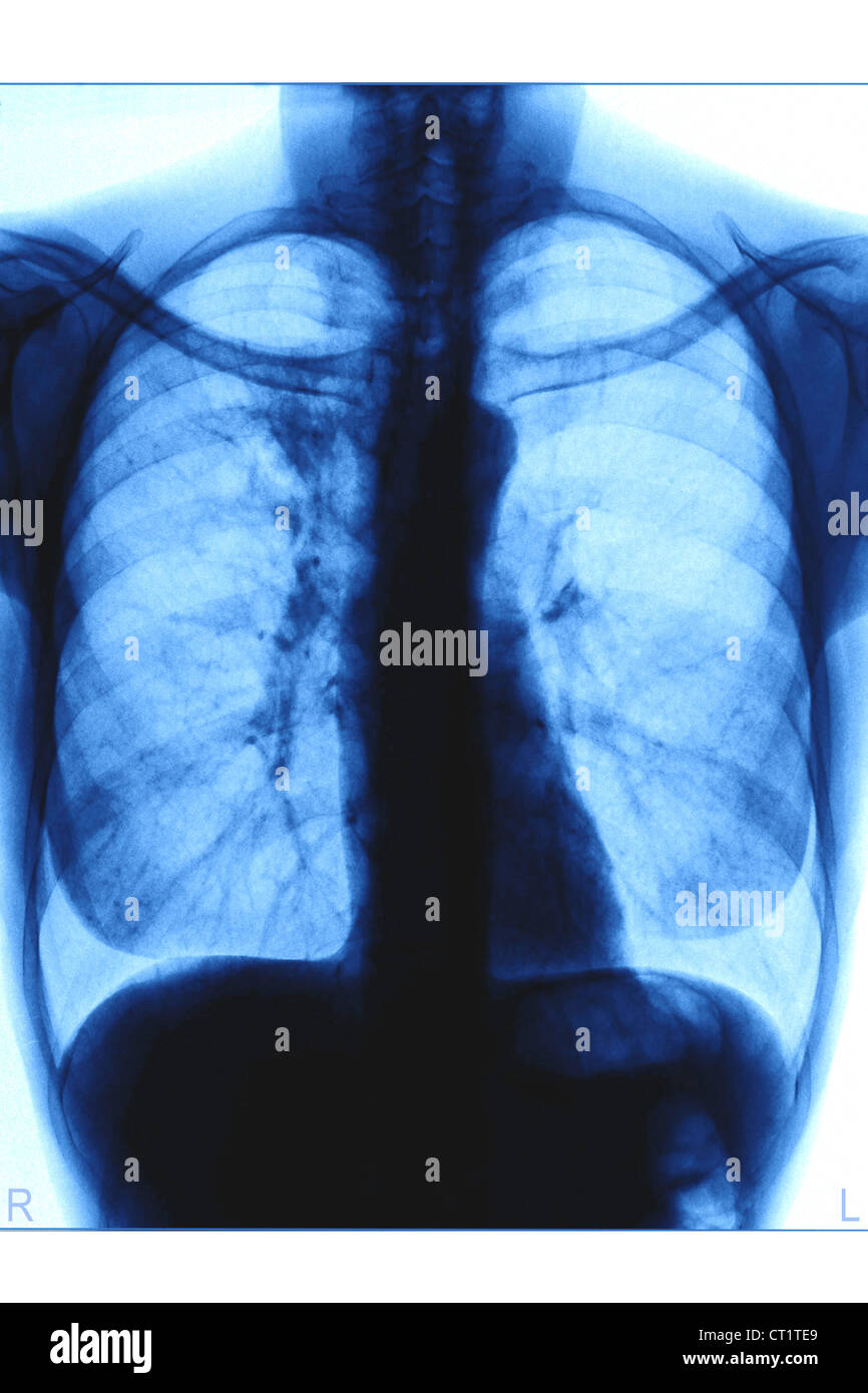 bronchial-cancer-x-ray-stock-photo-alamy