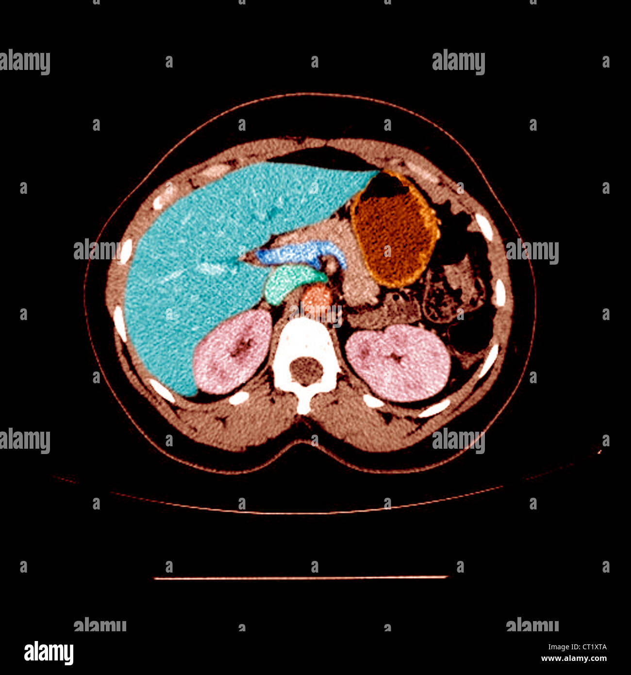 Kidney arteries scan hires stock photography and images Alamy