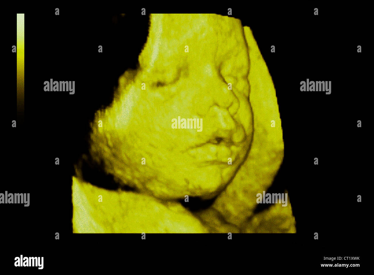3 month fetus hi-res stock photography and images - Alamy