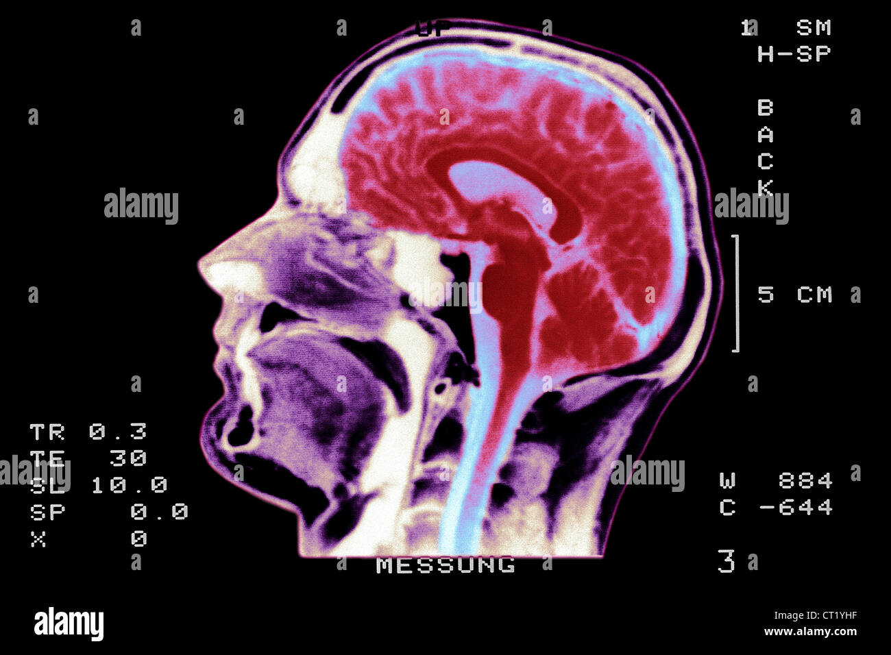 Normal brain scan hires stock photography and images Alamy