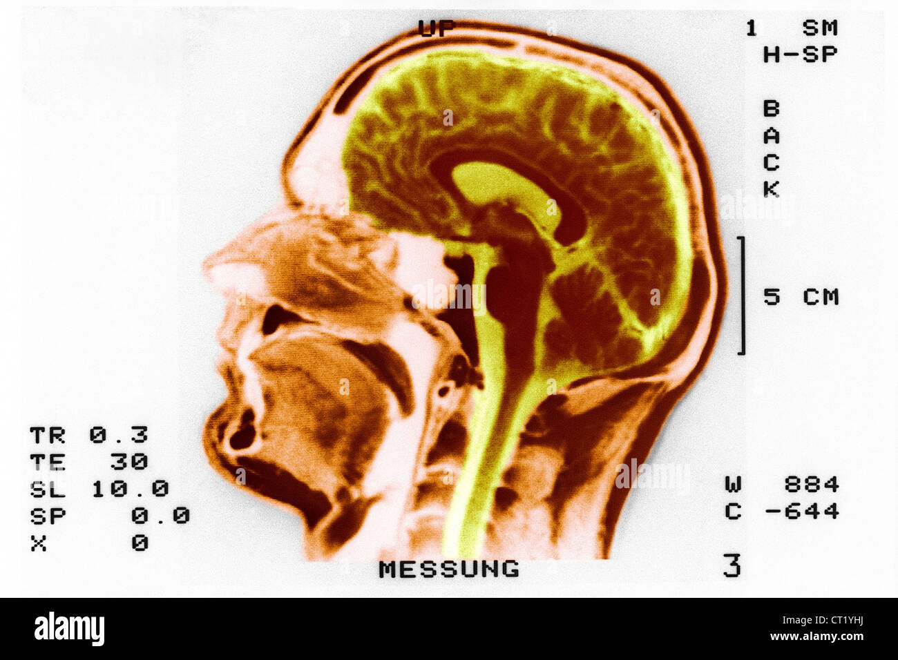Normal brain scan hires stock photography and images Alamy