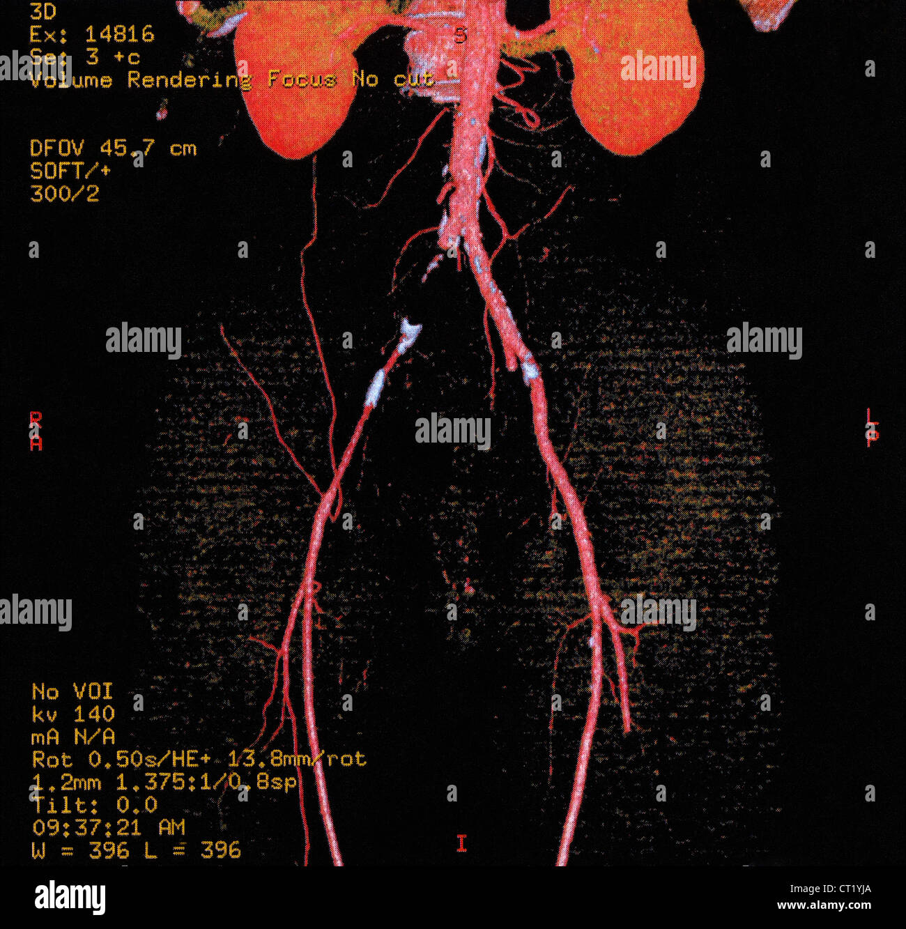 ILIAC THROMBOSIS, 3D SCAN Stock Photo