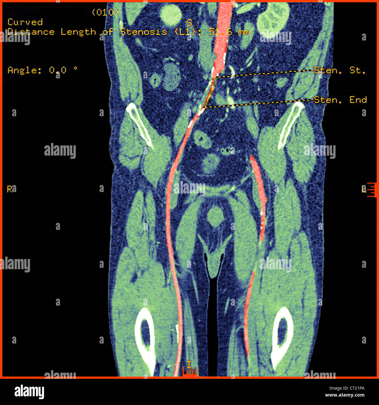 ABDOMINAL AORTA STENOSIS, SCAN Stock Photo Alamy