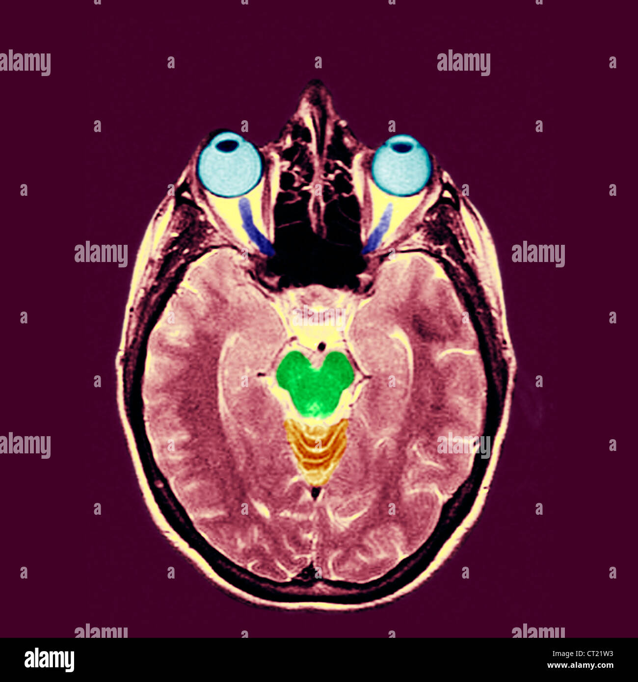 Optic nerve mri hires stock photography and images Alamy