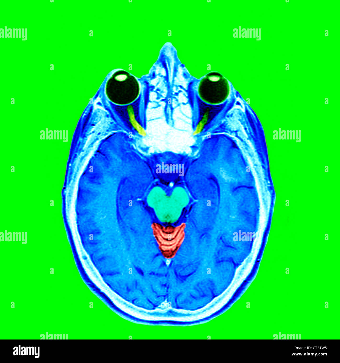 Optic nerve mri hires stock photography and images Alamy