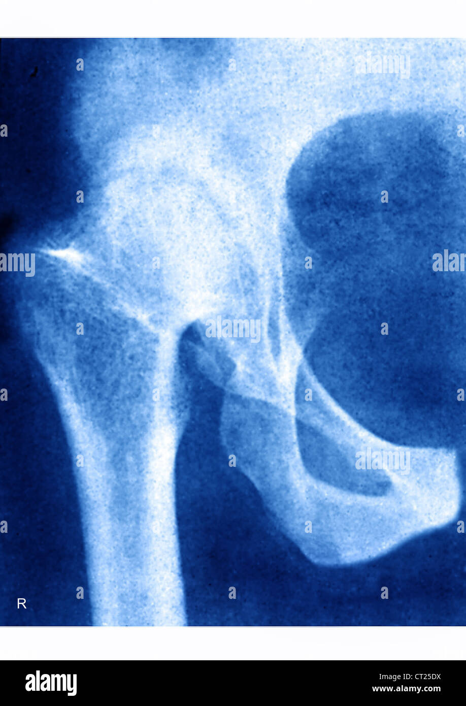 HIP OSTEOARTHRITIS, XRAY Stock Photo Alamy