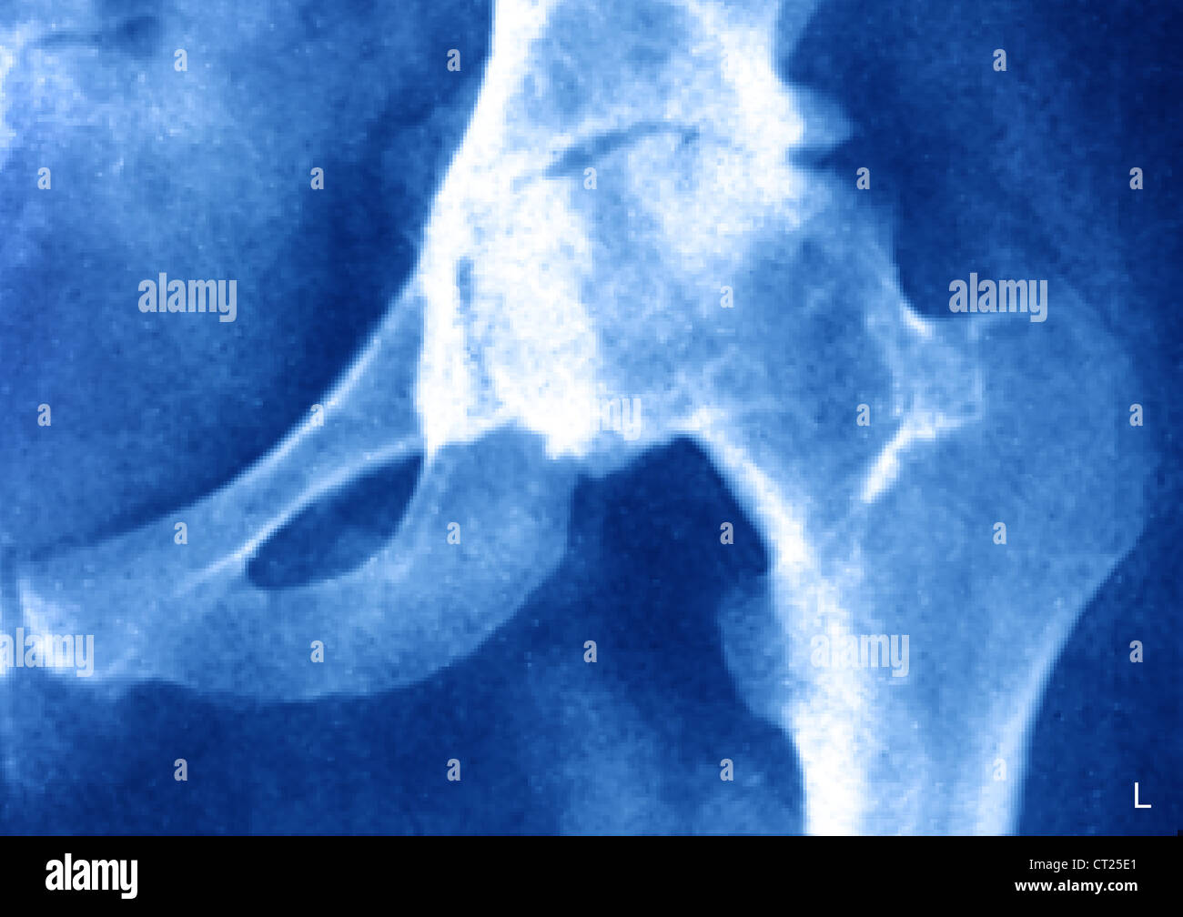 ARTHRITIS OF THE HIP, XRAY Stock Photo Alamy