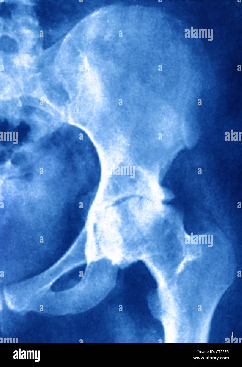 ARTHRITIS OF THE HIP, XRAY Stock Photo Alamy