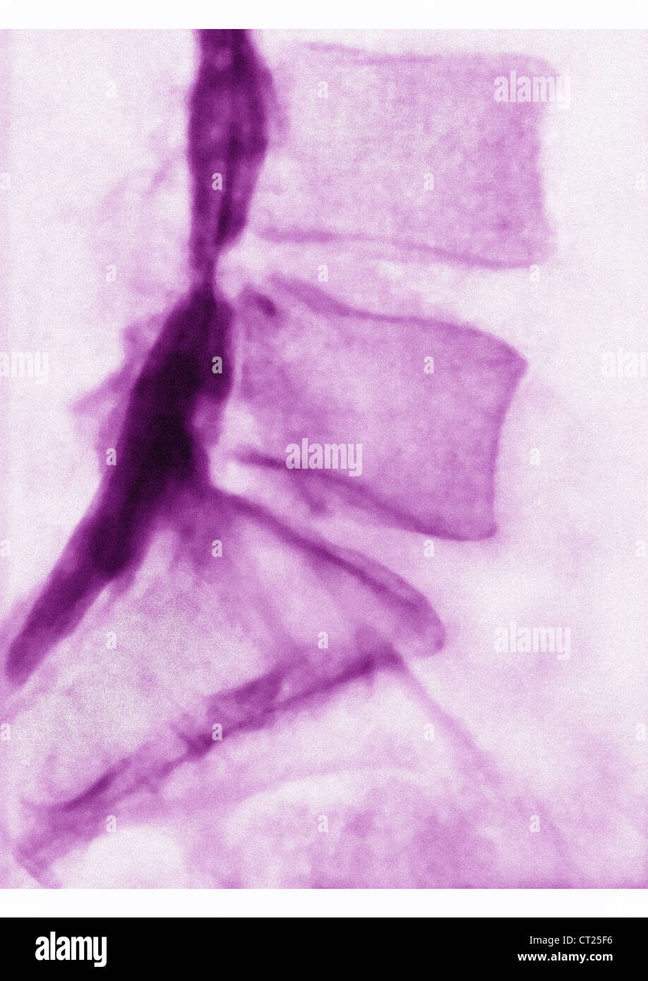 HERNIATED DISK, XRAY Stock Photo Alamy