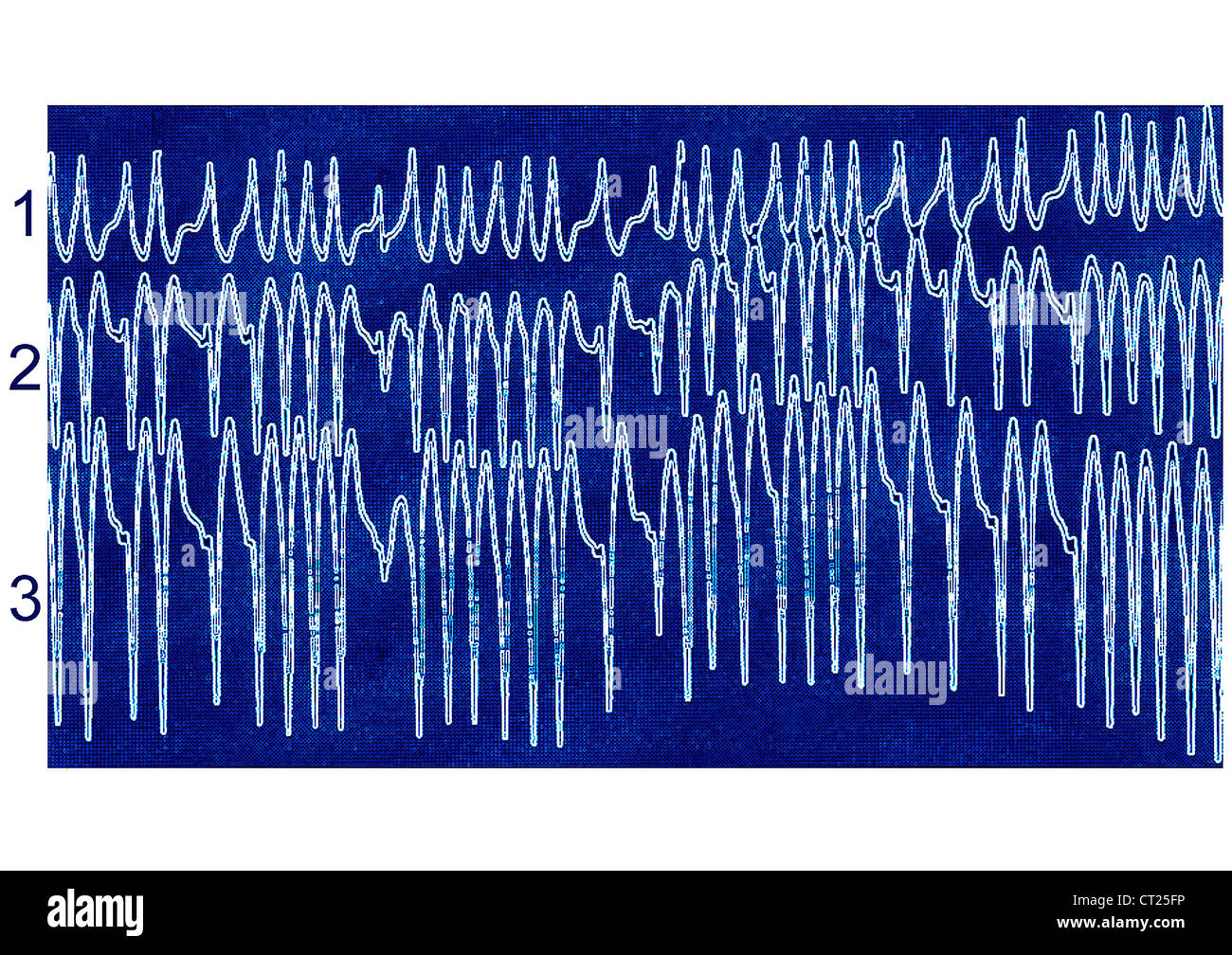 Atrial fibrillation ecg hi-res stock photography and images - Alamy