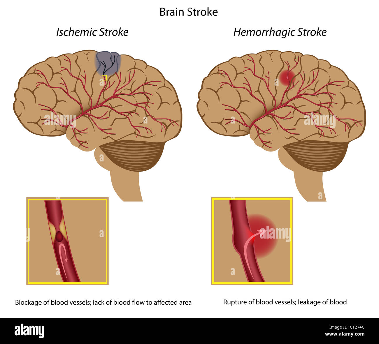 Hemorrhagic stroke hi-res stock photography and images - Alamy