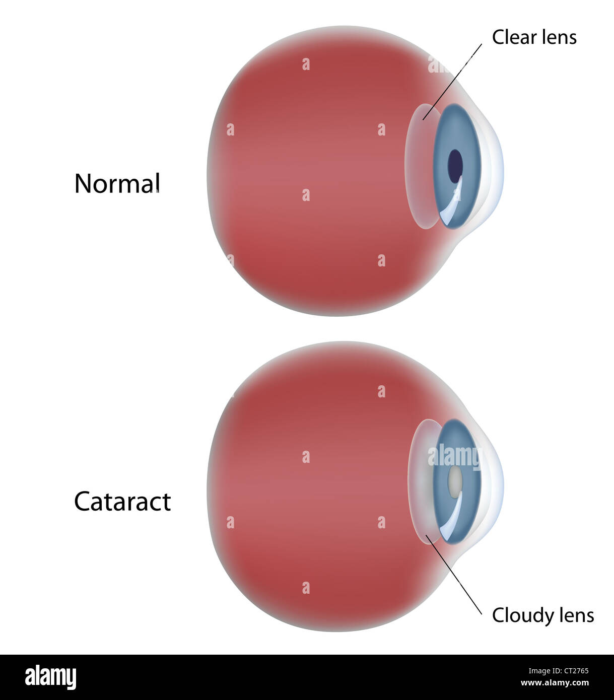 Eye disease - Cataract Stock Photo