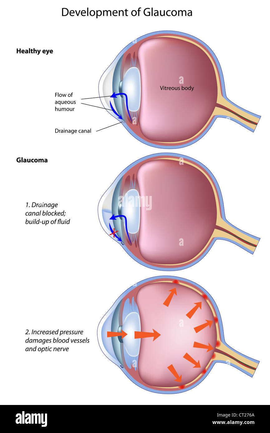Stages of glaucoma, a common eye disease Stock Photo