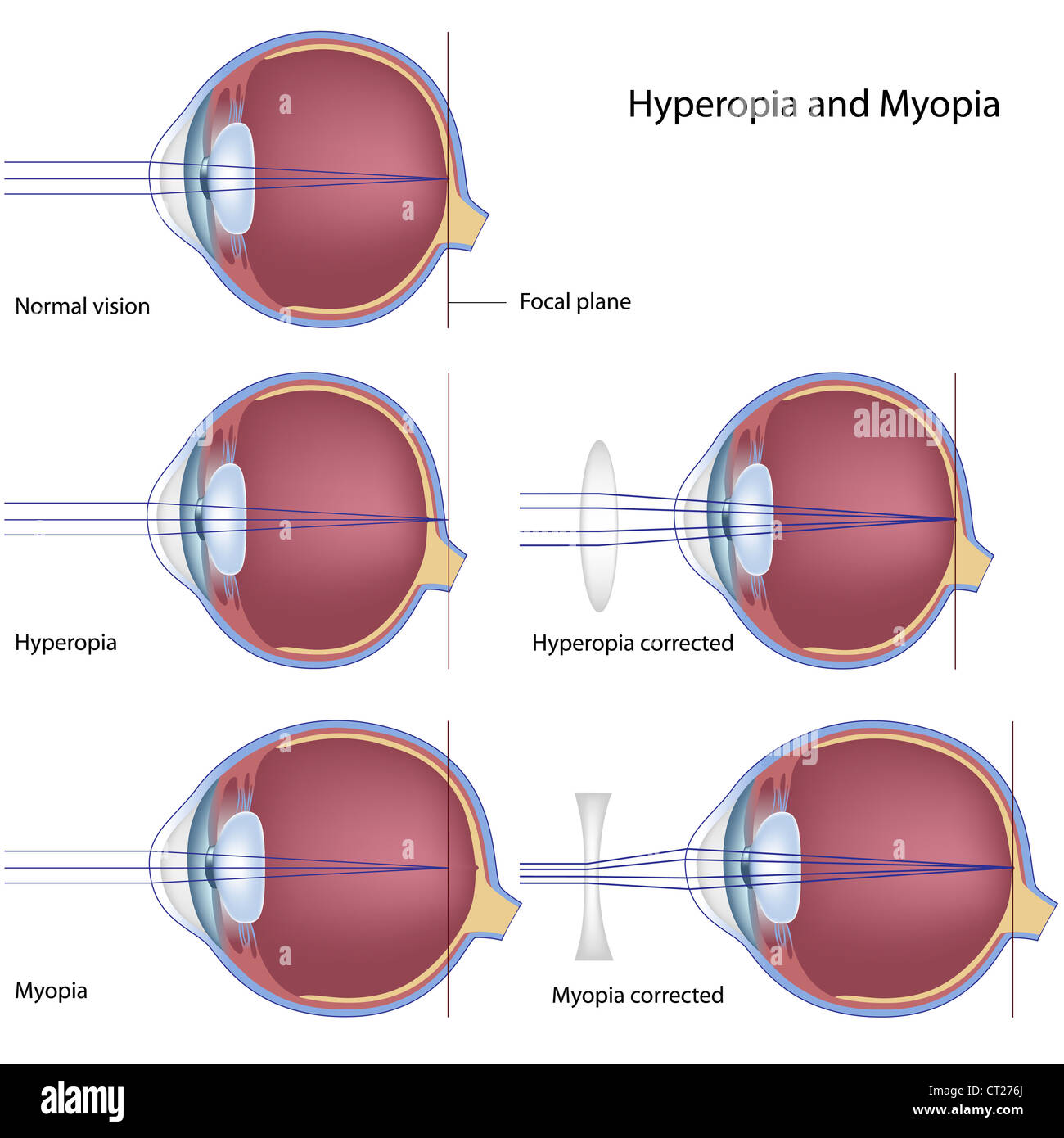 Myopia and hyperopia Stock Photo