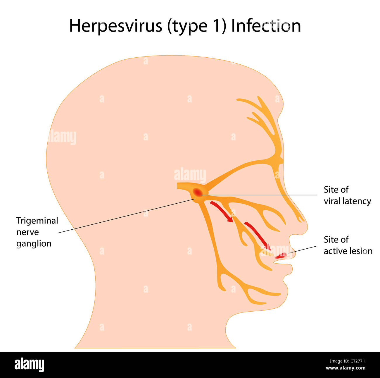 Herpesvirus infection (cold sores) Stock Photo