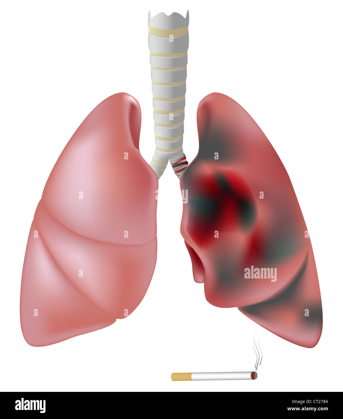 Smoker's lung (with tumor) vs healthy lung Stock Photo