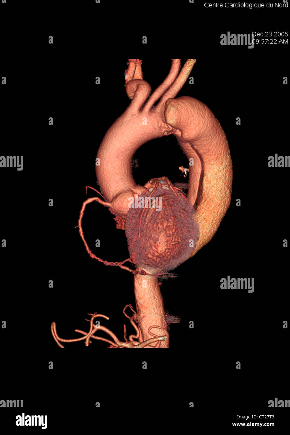 ANEURYSM OF THE AORTA, 3D SCAN Stock Photo - Alamy