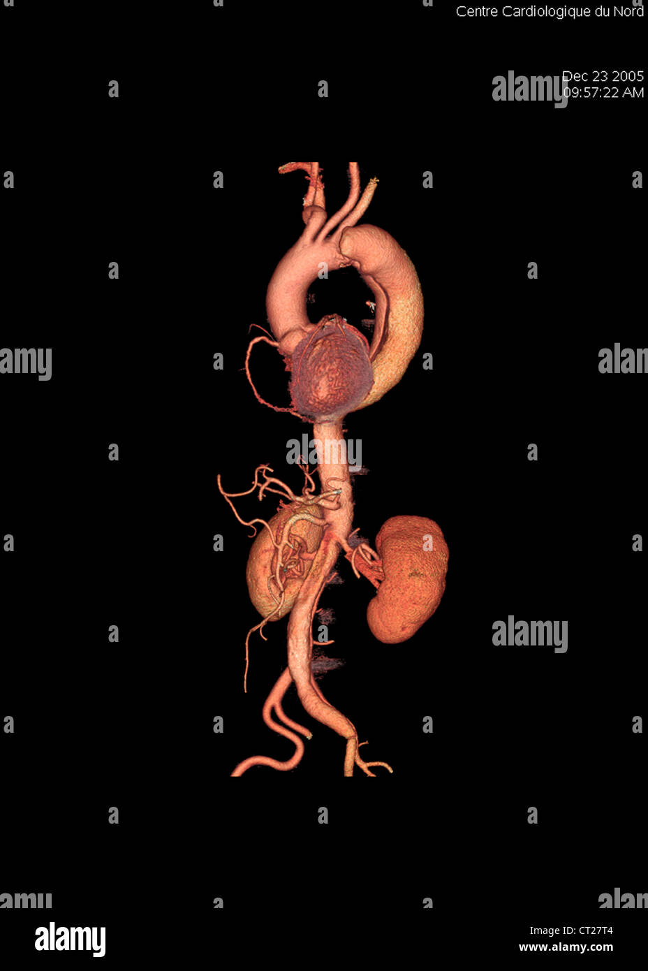 ANEURYSM OF THE AORTA, 3D SCAN Stock Photo