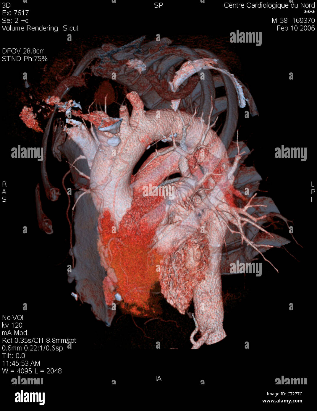 AORTA, 3D SCAN Stock Photo