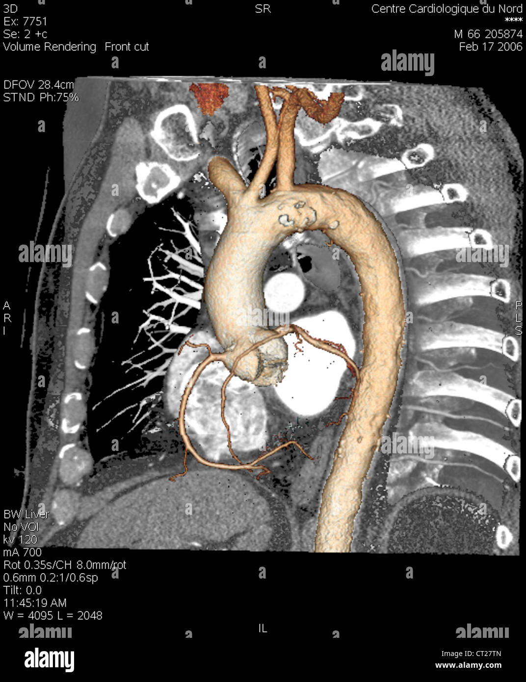 AORTA, 3D SCAN Stock Photo